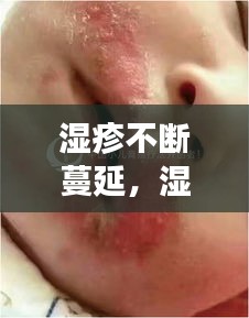 濕疹不斷蔓延，濕疹一直蔓延 