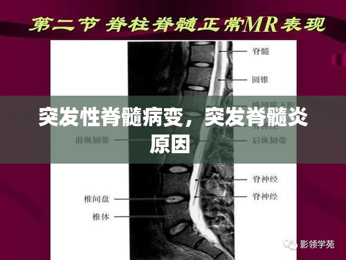 突發(fā)性脊髓病變，突發(fā)脊髓炎原因 