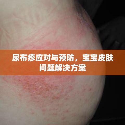 尿布疹應對與預防，寶寶皮膚問題解決方案